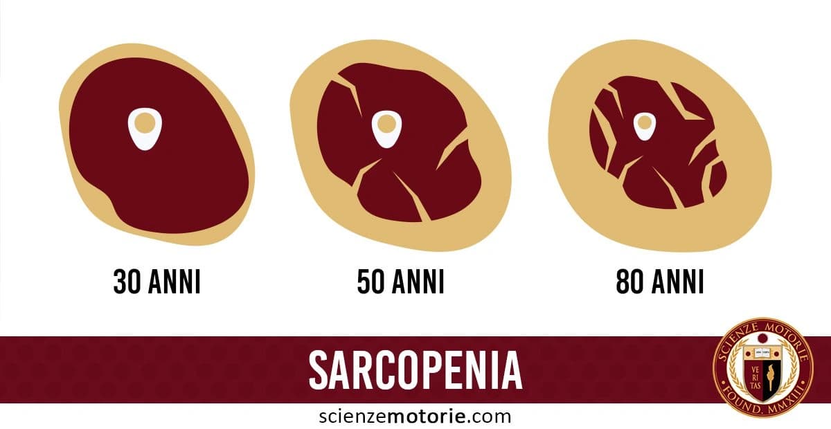 L'immagine mostra tre rappresentazioni di tessuto muscolare a diverse età: 30, 50 e 80 anni. A 30 anni, il muscolo appare pieno e compatto. A 50 anni, si notano segni di riduzione e la presenza di spazi vuoti nel tessuto. A 80 anni, il muscolo è ulteriormente ridotto e frammentato. Sotto le immagini, c'è la scritta "SARCOPENIA", che indica la perdita di massa e forza muscolare legata all'invecchiamento. Questo fenomeno è particolarmente rilevante in ambito medico e riabilitativo. nell'immagine è presente il logo di ScienzeMotorie.com