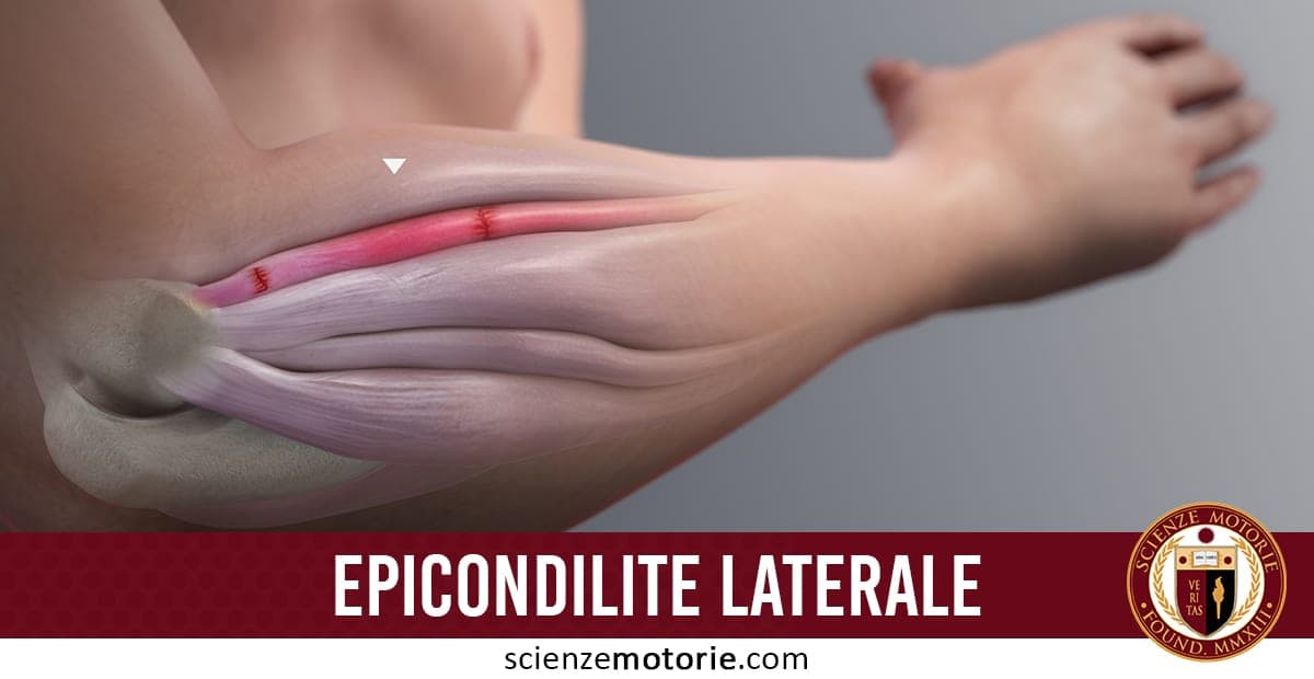 Epicondilite Laterale: Cause, Sintomi e Trattamento