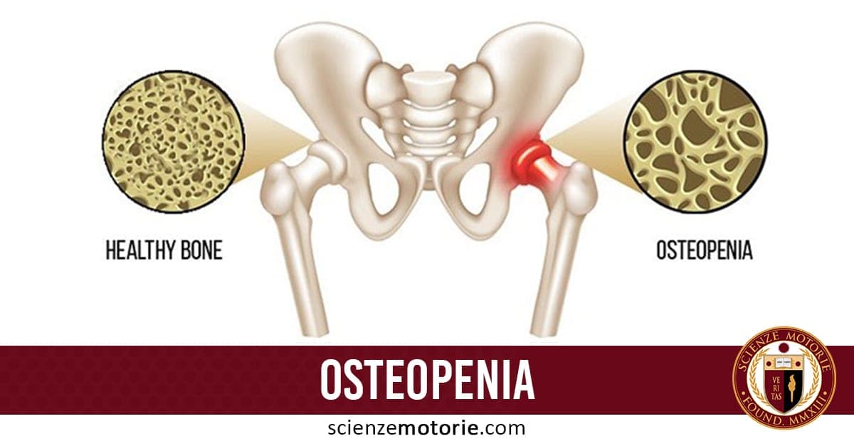 Cos’è Osteopenia? Come si può prevenire?