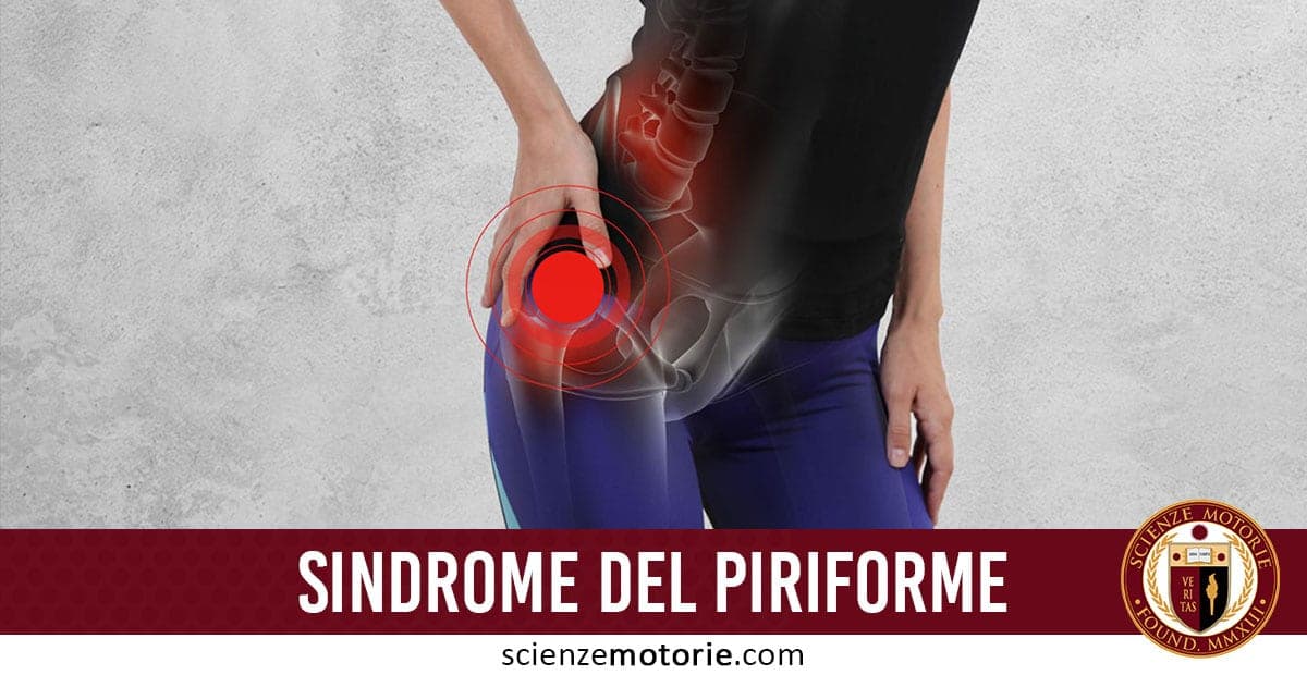 Sindrome del Piriforme: cos’è e come va Trattata