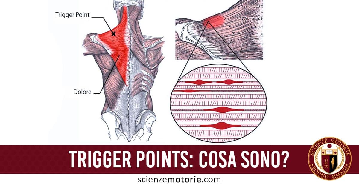 Trigger Points: cosa sono e come curarli