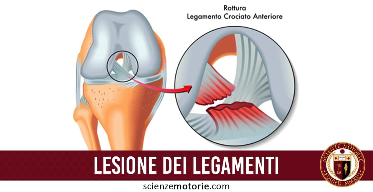 Illustrazione di un ginocchio con lesione del legamento crociato anteriore (LCA) e dettaglio dell’area lesionata.